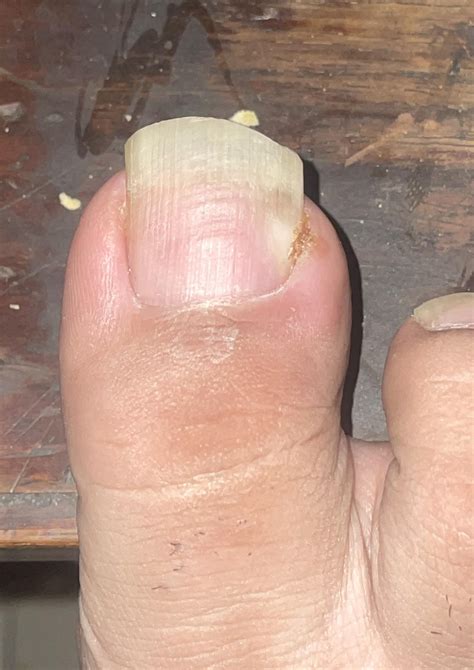 Ingrown Toenail : r/medical_advice