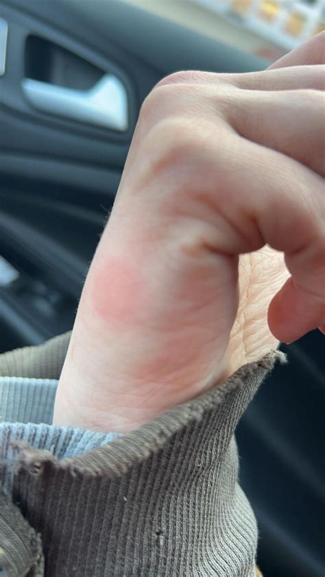 What is this itchy welts on my hands and arms? : r/DermatologyQuestions