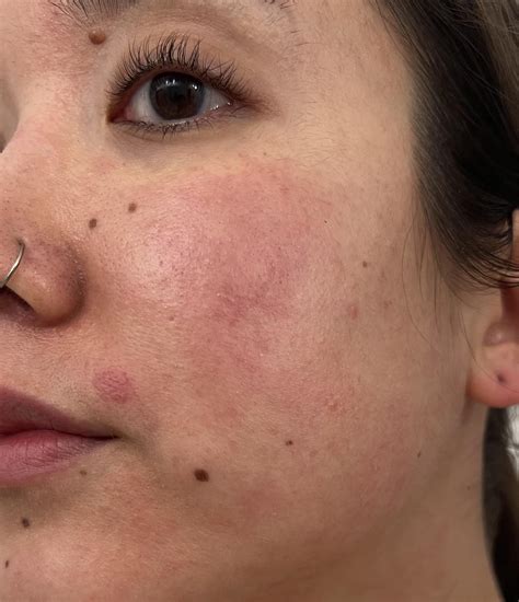 Starting Ivermectin : r/Rosacea