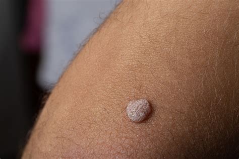 Common Wart Study - GetInAStudy.com