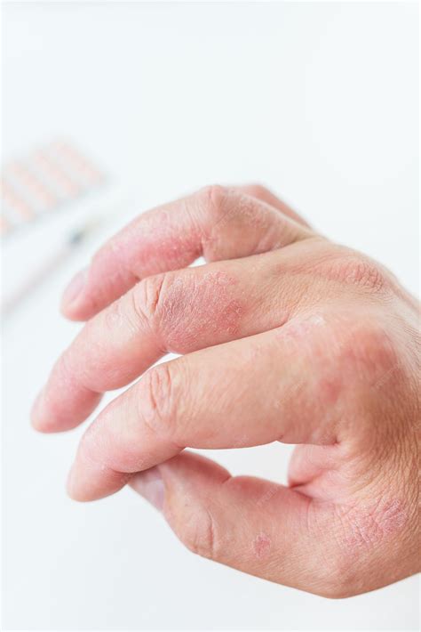 Premium Photo | A man shows a reddening rash on his hands the causes of