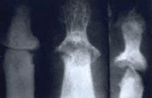 psoriatic arthritis