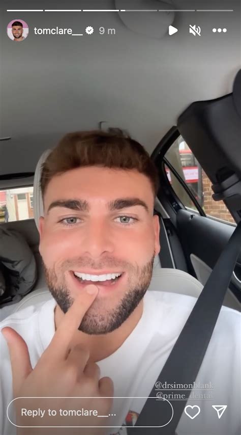 Love Island's Tom Clare unveils teeth transformation and WOW