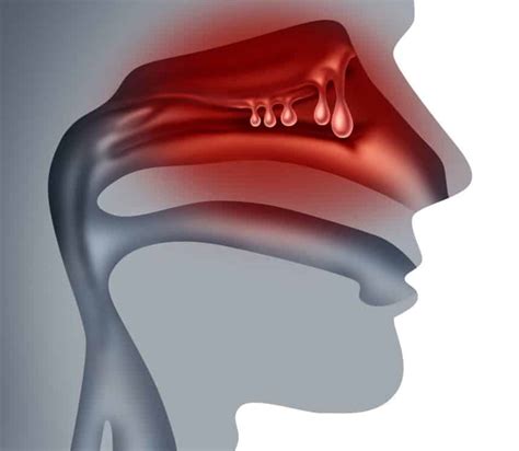 Nasal Polyp (Nasal Polyp) - Prof. Dr. Fadlullah AKSOY