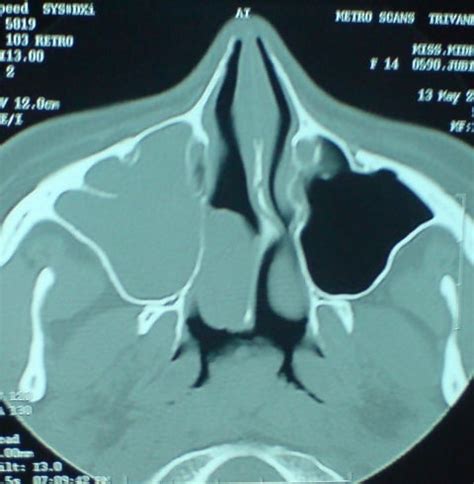 Killian's Antro Choanal Polyp