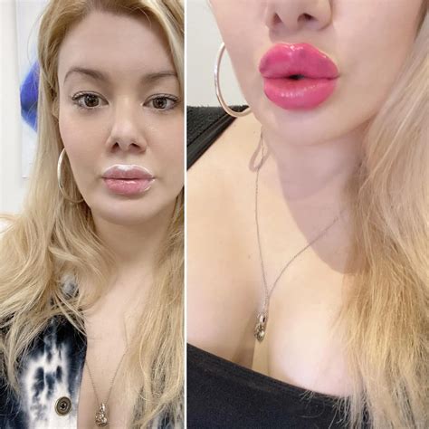 NEW big juicy lips for sucking 😍💉💋 | Scrolller