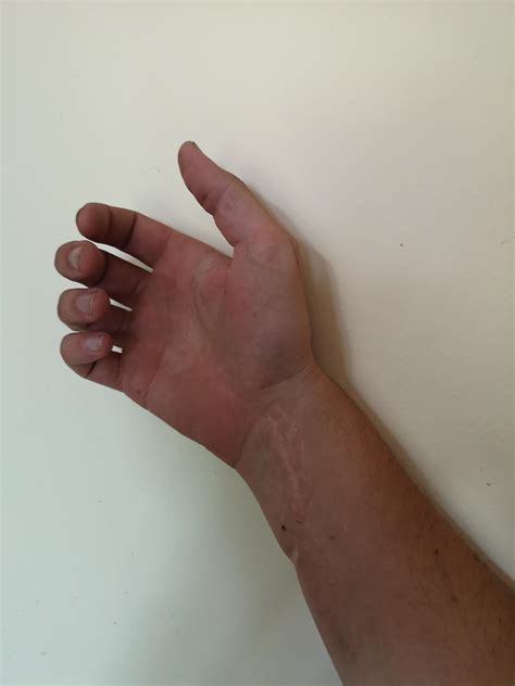 Old surgical scar that leads to the center of my palm. : r/hands