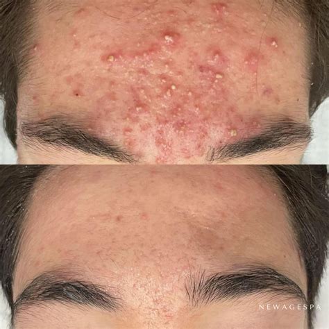 Peel - Facial Anti-Acne Peel - NEW AGE SPA