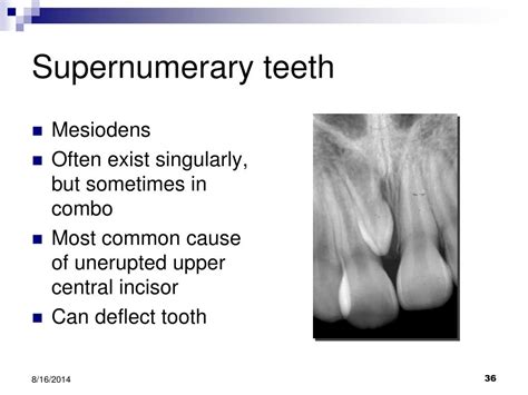 hypodontia supernumerary teeth powerpoint