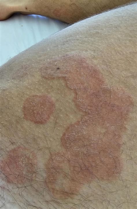 The Doctor's - Any chance this is not ringworm? (I've seen multiple