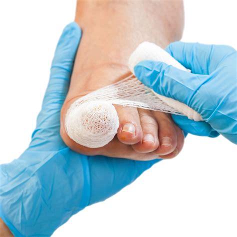 Ingrowing Toenail Surgery - Neat Sweet Feet, Penarth