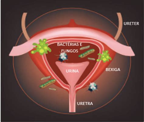 Infecção Urinária É Perigosa - INFECÇÃO URINÁRIA