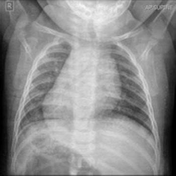 Situs Inversus with Dextrocardia