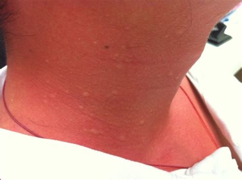 Severe Allergic Reactions to Bed Bugs - Professional Pest Manager