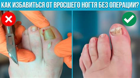 ТОП-3 СОВЕТА КАК ИЗБАВИТЬСЯ ОТ ВРОСШЕГО НОГТЯ БЕЗ ОПЕРАЦИИ И ХИРУРГА ...