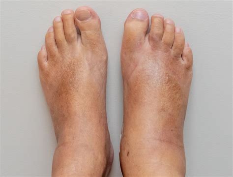 herbal remedies  reduce body swelling edema ayurvedic treatment