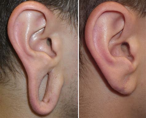 Gauged Earlobe Repair Richmond VA | Repair Earlobe Midlothian