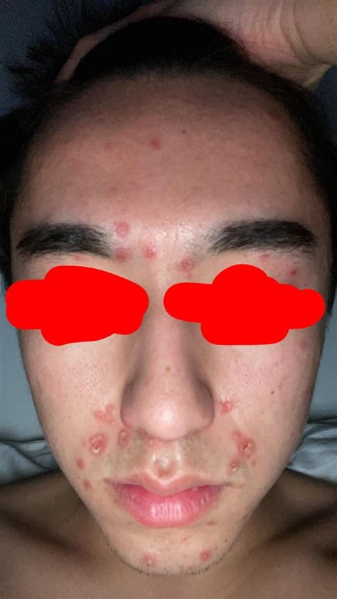 impetigo  hands foot mouth rdiagnoseme