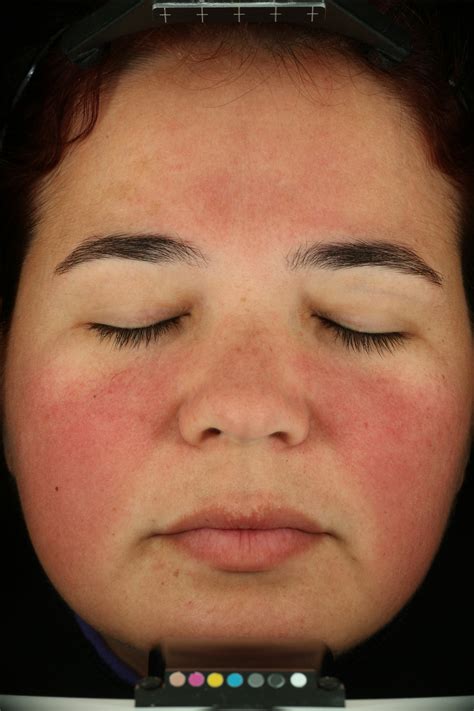 When Is Acne Not Acne? These 3 Skin Conditions Are Often Mistaken For A