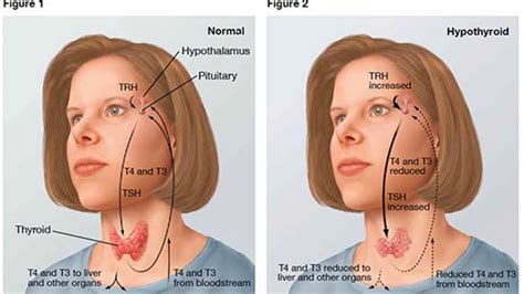 [DIAGRAM] Diagram Of Goiter - MYDIAGRAM.ONLINE