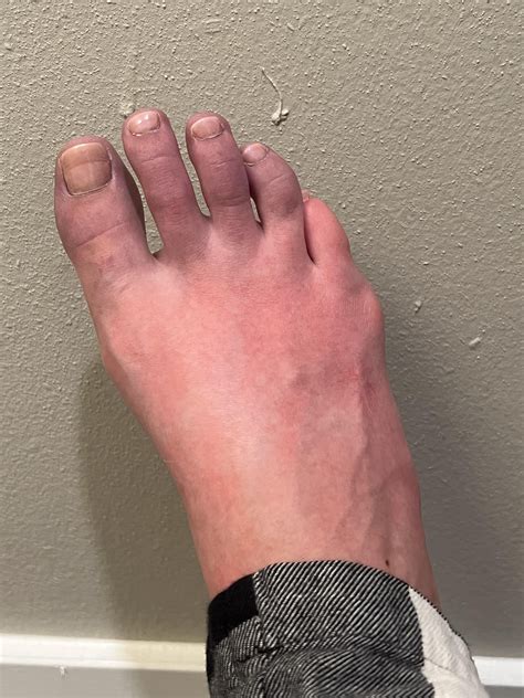 Severe case : r/Erythromelalgia