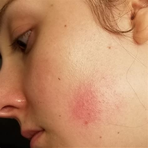 Keratosis rubra faceii? My gp said rosacea, gave me metro gel, and