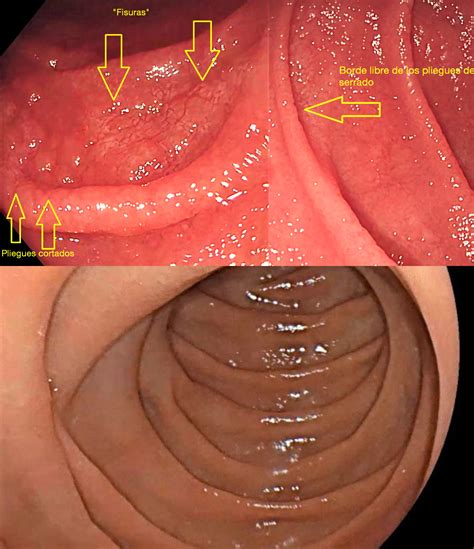 Duodeno Celiaco Vs Normal