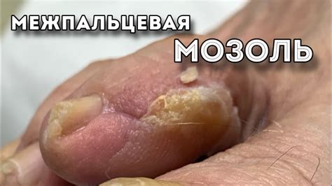Сухая мозоль между пальцев - YouTube