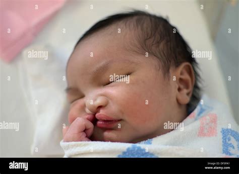 Newborn baby with cleft lip and palate sleeping Stock Photo - Alamy