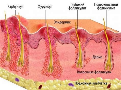 Как лечить фурункул на лице в домашних условиях