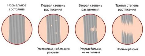 Растяжение связок локтевого сустава: причины, симптомы, лечение, в ...