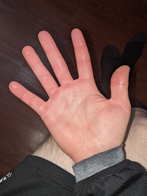 Suspected Erythromelagia : Erythromelalgia