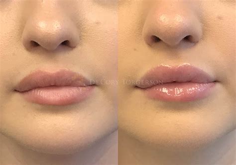 Lip Flip Before & After Gallery | Dr. Cory Torgerson