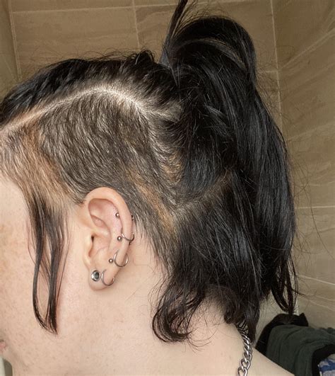 Poliosis
