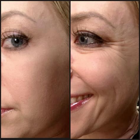 Which procedure(s) would STOP me from wrinkling like a shar-pei dog