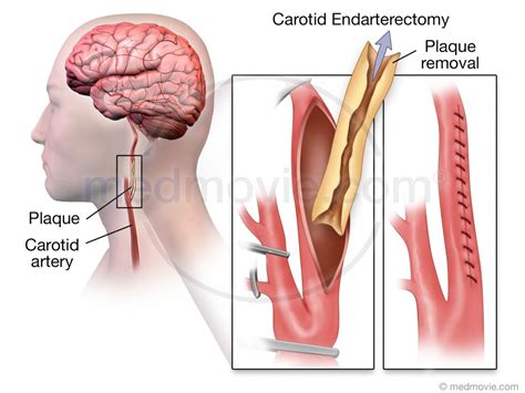 Medmovie.com | Carotid Artery Surgery