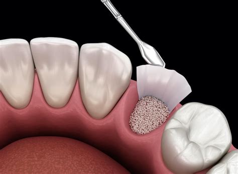 Dental Bone Graft: Everything you need to know