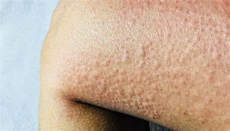 Alergia A Agua Sanitaria