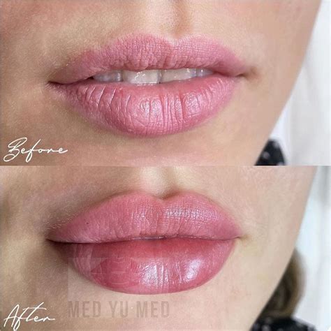 MED_YU_MED|cosmetology on Instagram: “Коррекция губ😻 До или после ...
