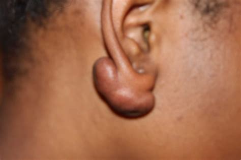 keloid shrinking injections drderme skin clinics