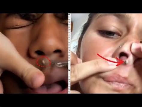 Unbelievable Blackhead Removal 2024: The Ultimate Guide for 2024 - rwjo2jb