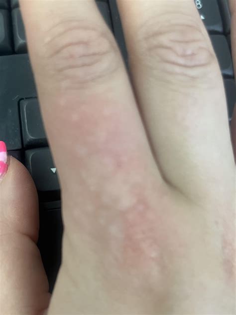 Ongoing itchy bumps flaring up on fingers and hands. Does anyone know