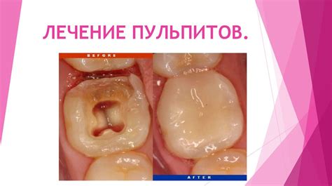 Лечение пульпитов - презентация онлайн