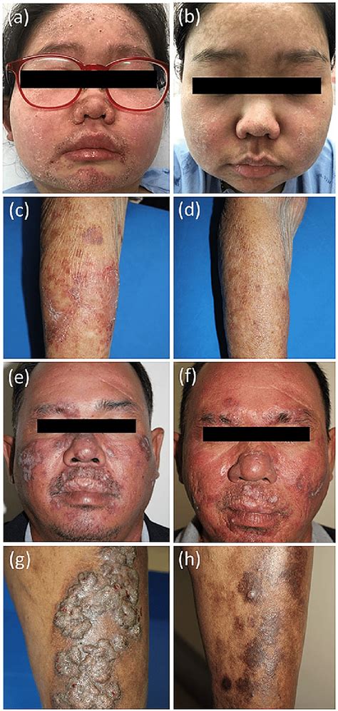 Cutaneous Lupus Face