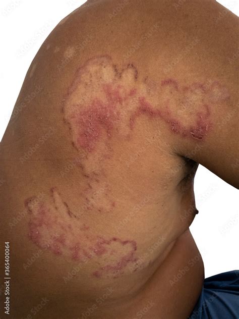 close    skin fungal infection tinea corporis stock photo
