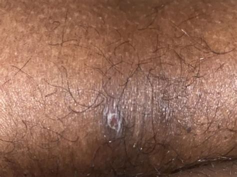boils? ingrowns? hs? : r/SkincareAddicts