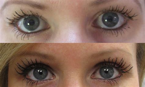 Eyelash Treatment Before and After Photos | Latisse | Woodbridge, Vaughan