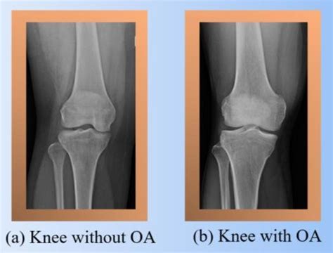 normal  knee oa condition  scientific diagram
