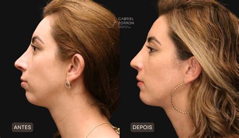 Perfiloplastia O Que É