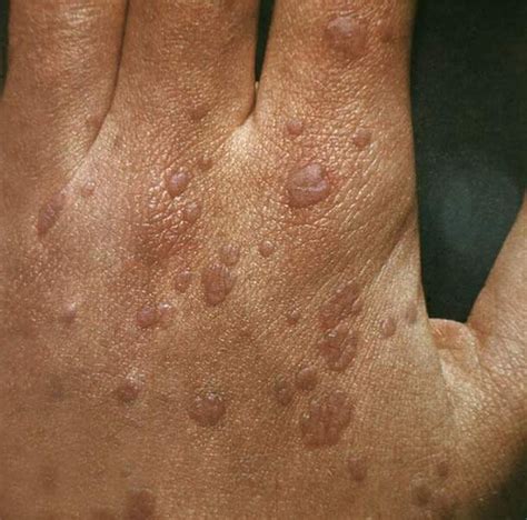 Flat Warts: Symptoms, Causes, and Ways of Treatment - Med Warts